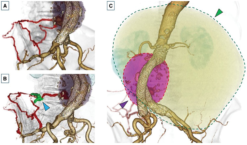 Late Open Conversion with Graft Replacement after Endovascular Aortic Repair along with Removal of a Giant Ovarian Tumor: A Case Report.