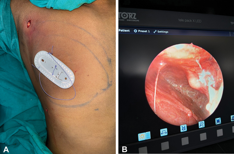 Gynecomastia Surgery: Liposuction Alone versus Liposuction with Endoscope-Assisted Glandular Excision-A Comparative Study.
