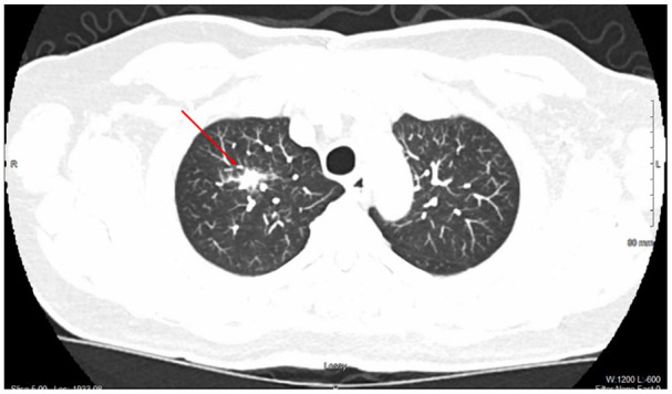 MALToma with a 'B'-Not for Benign, but for Bronchus-Associated: A Rare Case of Bronchus-Associated Lymphoid Tissue Lymphoma.