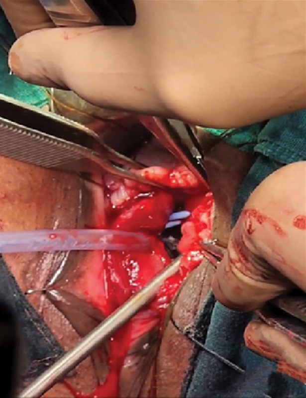 Use of Dermal Regeneration Template in Closure of a Large Vesicovaginal Fistula: An Initial Report.