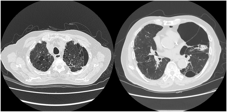 Relatively Safer and Efficient Pleurodesis With 50% DW for Very Elderly Patients With Secondary Spontaneous Pneumothorax: Report of 2 Cases.