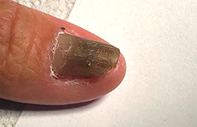 Rhodotorula mucilaginosa (A. Jörg.) F.C. Harrison 1928 and onychomycosis: three case reports for an unusual and underestimated combo.