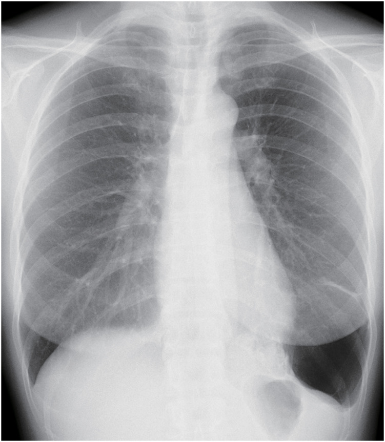 Delayed Diagnosis of Primary Pulmonary Sarcoma Arising from a Pulmonary Cyst in an Adult: A Case Report.