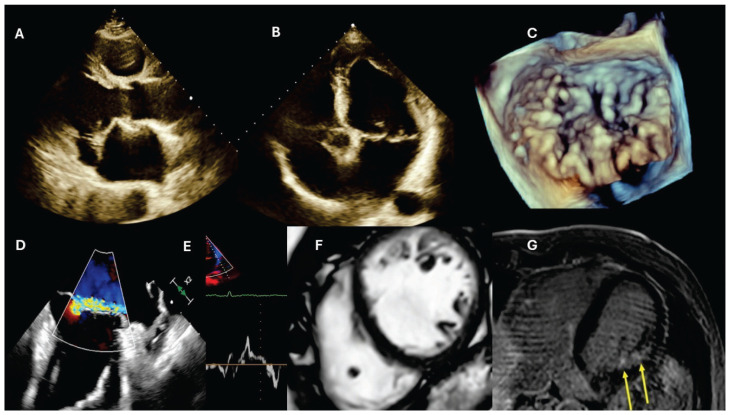 Unique coincidence of mitral valve prolapse and left ventricular hypertrabeculation in a patient with ventricular arrythmia.