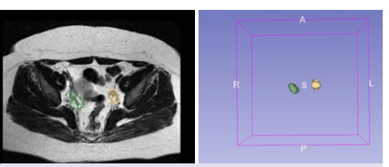 Predictive value of machine learning-based T2-weighted MRI radiomics in the diagnosis of polycystic ovary syndrome.