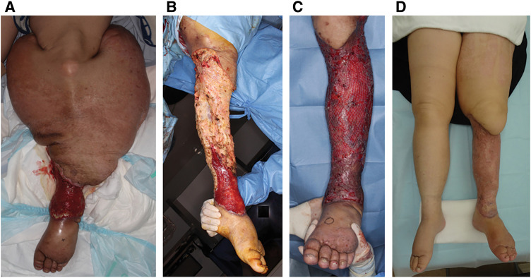 Massive Lymphedema in the Calf Complicated by Severe Skin Fibrosclerosis.