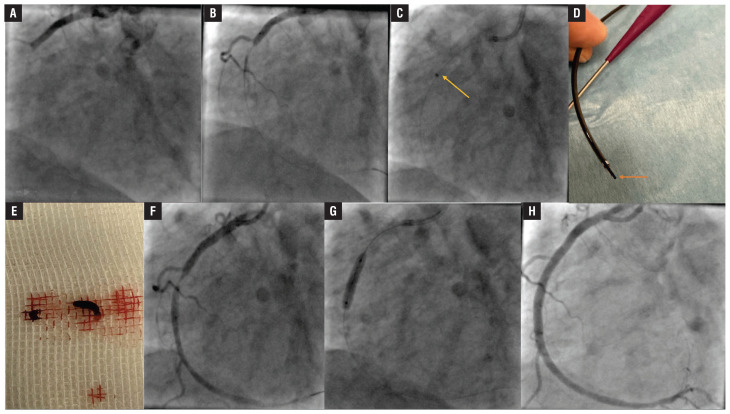 Continuous mechanical aspiration thrombectomy for STEMI with high thrombus burden.