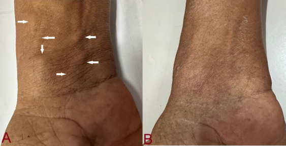 The thrill is vanished: Percutaneous exclusion of post trans radial arteriovenous fistula using stent graft through transbrachial approach.