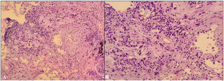 Cardiac Tamponade as the Initial Presentation of Squamous Cell Carcinoma of the Lung: A Case Report and Literature Review.