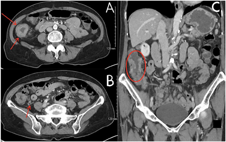 Immunotherapy With Pembrolizumab for Resectable dMMR/MSI-H Stage III Colon Cancer: A Case of Personalized, Precision Surgery-Sparing Immunotherapy.