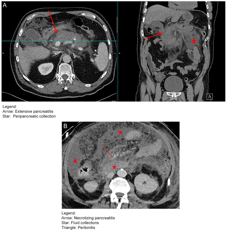 A Fatal Case of Acute Necrotizing Pancreatitis Following a COVID-19 Vaccine.