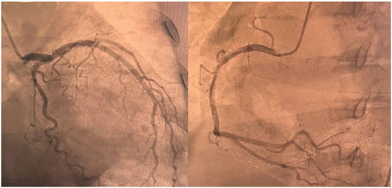 When the ECG Deceives: A Case of Pseudo-Wellens' Syndrome in the Setting of Stress-Induced Cardiomyopathy.