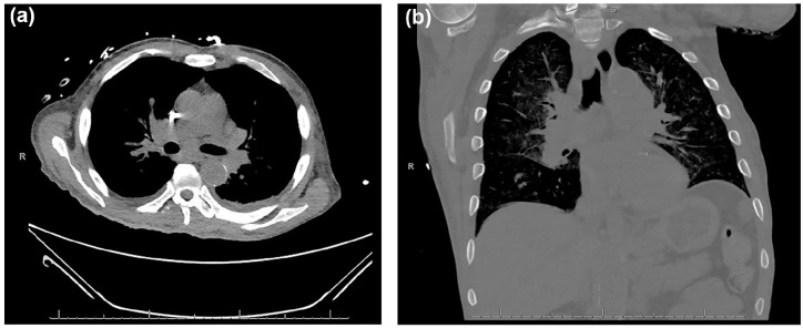 New Sarcoidosis Diagnosis Following Unresponsive Event During Hemodialysis.
