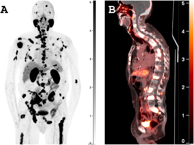 The potential of generative AI with prostate-specific membrane antigen (PSMA) PET/CT: challenges and future directions.