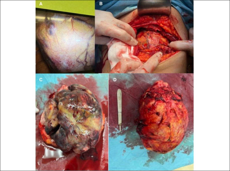 Urinary incontinence as the first clinical symptom of urinary bladder leiomyosarcoma.