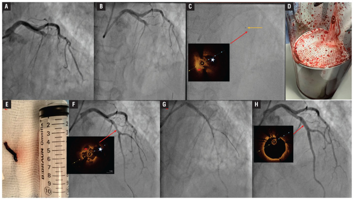 Continuous mechanical aspiration thrombectomy for STEMI with high thrombus burden.