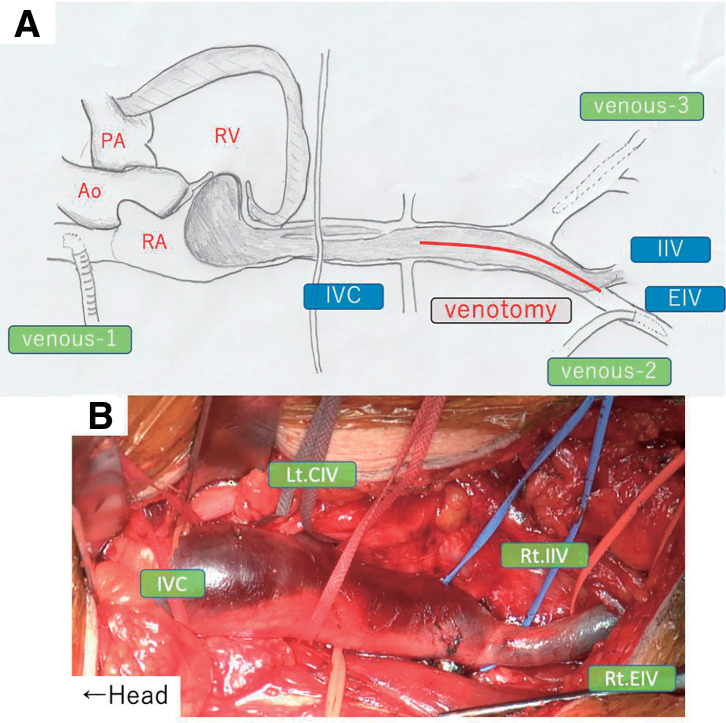 Surgical Strategy of Intravenous Leiomyomatosis with Intracardiac Extension: A Case Report.