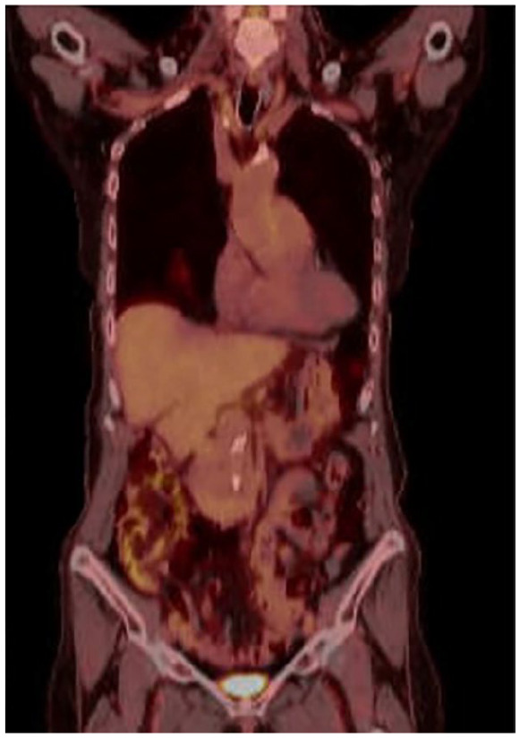 Immunotherapy With Pembrolizumab for Resectable dMMR/MSI-H Stage III Colon Cancer: A Case of Personalized, Precision Surgery-Sparing Immunotherapy.