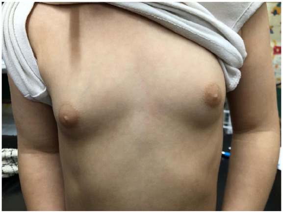 Early Manifestation of McCune-Albright Syndrome in a 32-Month-Old Female: A Rare Case Report.