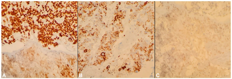 Cardiac Tamponade as the Initial Presentation of Squamous Cell Carcinoma of the Lung: A Case Report and Literature Review.