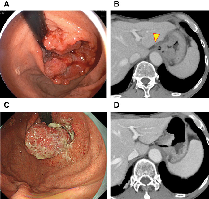 Postoperative Solitary Brain Metastasis from Residual Gastric Cancer: A Rare Case Report.