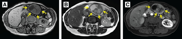 A Case of Gastric Neuroendocrine Carcinoma with Disseminated Recurrence 14 Years after Initial Surgery.