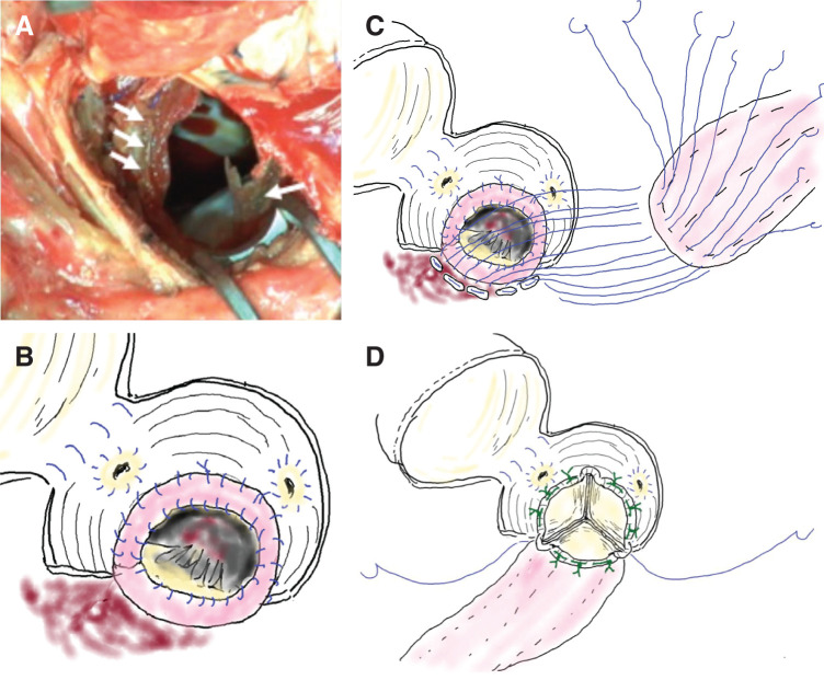 Aortic Valve Replacement with Annular Patch Reconstruction for Prosthetic Valve Endocarditis after the Bentall Procedure: A Case Series.
