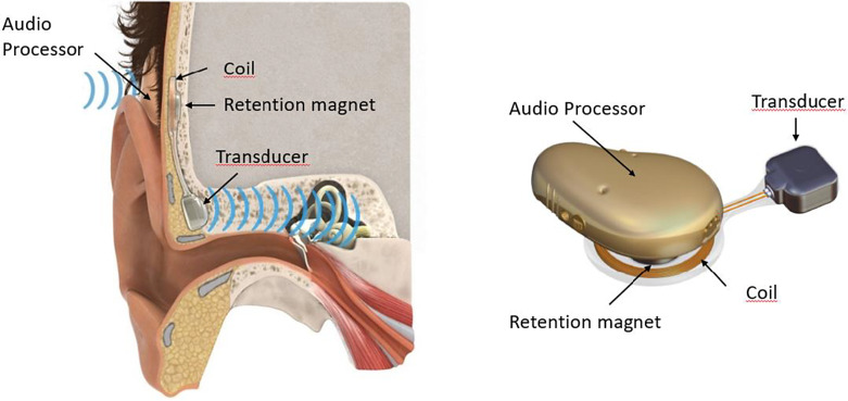 Patients' Experiences of an Active Transcutaneous Implant: The Bone Conduction Implant.