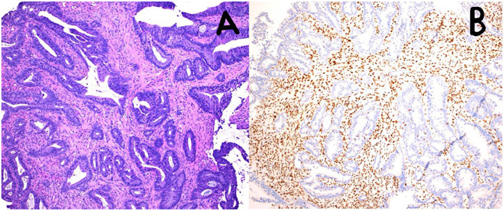 Immunotherapy With Pembrolizumab for Resectable dMMR/MSI-H Stage III Colon Cancer: A Case of Personalized, Precision Surgery-Sparing Immunotherapy.