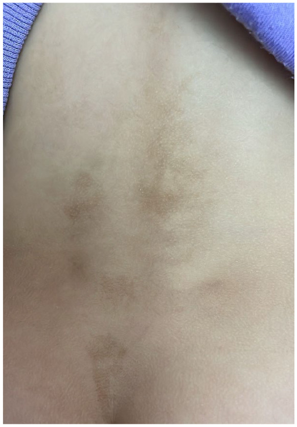 Early Manifestation of McCune-Albright Syndrome in a 32-Month-Old Female: A Rare Case Report.