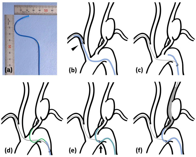 Carotid blowout syndrome as a late complication of carotid stenting in irradiated neck: covered stent treatment using the "No-Touch" technique.