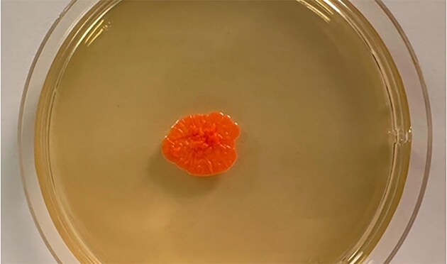 Rhodotorula mucilaginosa (A. Jörg.) F.C. Harrison 1928 and onychomycosis: three case reports for an unusual and underestimated combo.