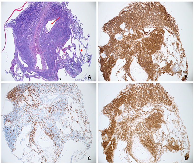MALToma with a 'B'-Not for Benign, but for Bronchus-Associated: A Rare Case of Bronchus-Associated Lymphoid Tissue Lymphoma.
