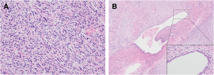 Delayed Diagnosis of Primary Pulmonary Sarcoma Arising from a Pulmonary Cyst in an Adult: A Case Report.