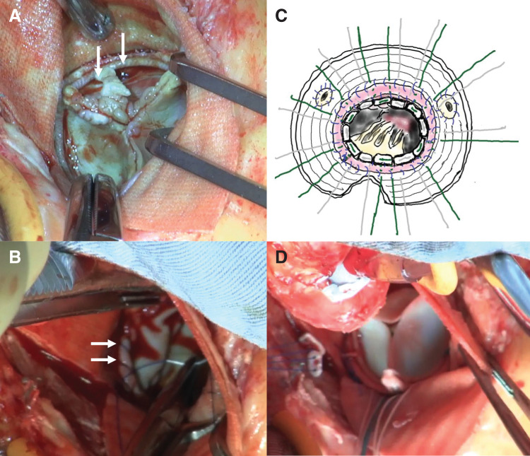 Aortic Valve Replacement with Annular Patch Reconstruction for Prosthetic Valve Endocarditis after the Bentall Procedure: A Case Series.
