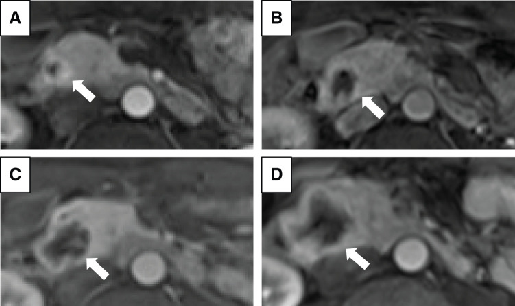 Pancreatic Hemangioblastoma in a Patient with von Hippel-Lindau Disease: A Case Report.