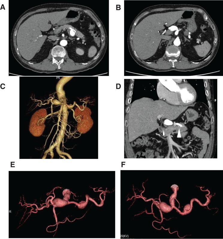 Hybrid Approach for Multiple Visceral Aneurysms with Isolated Dissection at the Superior Mesenteric Artery: A Case Report.