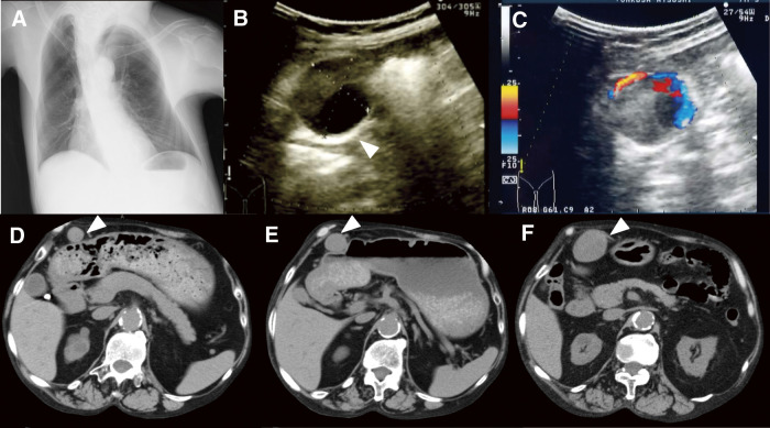 Acute Inflammatory Pseudoaneurysm of the Gastroepiploic Artery in a Patient with Multiple Aneurysms: A Case Highlighting Systemic Vascular Remodeling.