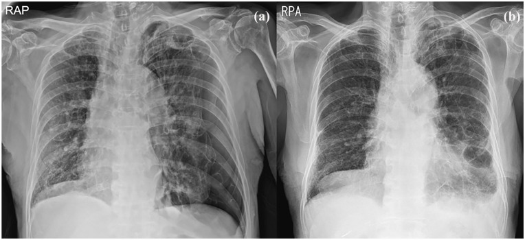 Relatively Safer and Efficient Pleurodesis With 50% DW for Very Elderly Patients With Secondary Spontaneous Pneumothorax: Report of 2 Cases.