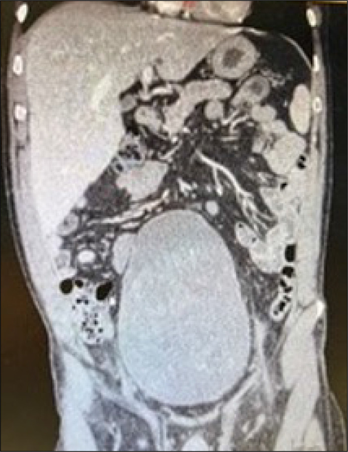 Urinary incontinence as the first clinical symptom of urinary bladder leiomyosarcoma.