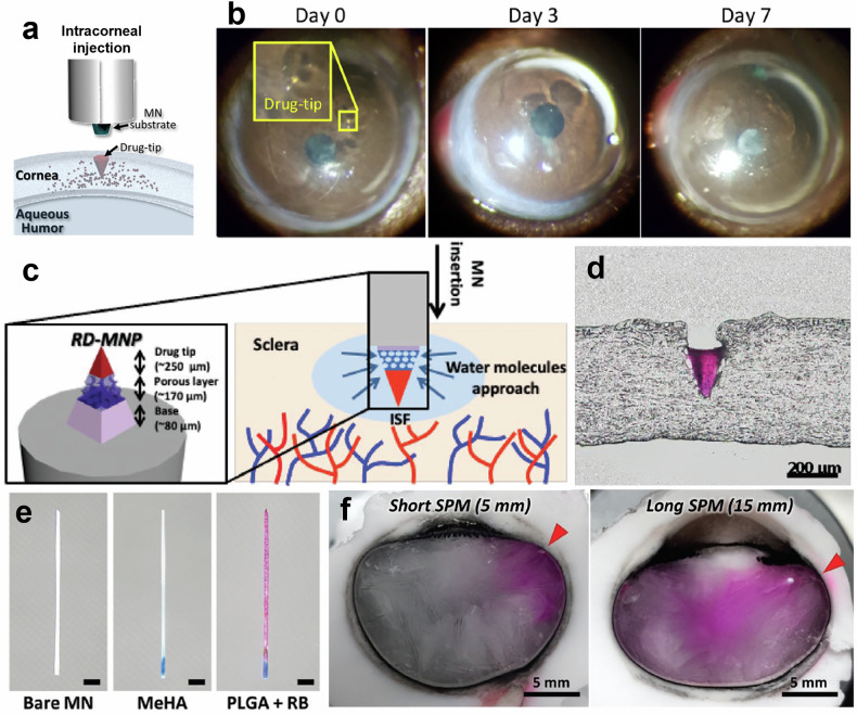 Microneedles for controlled and sustained intraocular drug delivery.