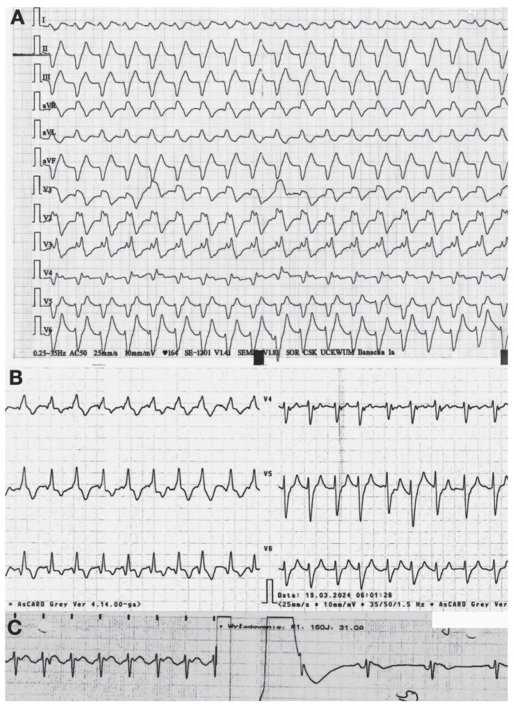 Hyperkalemia: Is it always about slow rhytm?