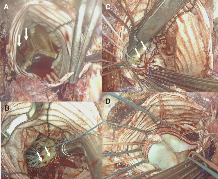 Aortic Valve Replacement with Annular Patch Reconstruction for Prosthetic Valve Endocarditis after the Bentall Procedure: A Case Series.