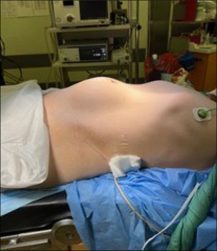 Urinary incontinence as the first clinical symptom of urinary bladder leiomyosarcoma.