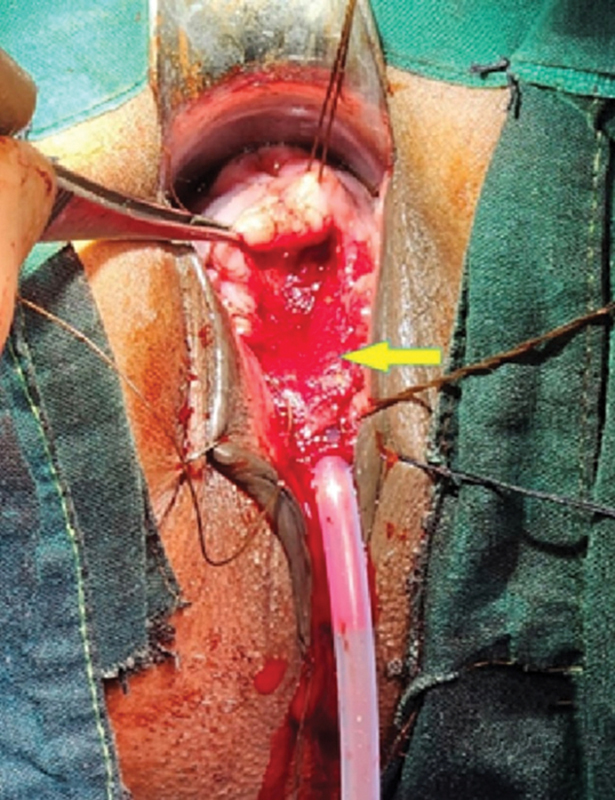 Use of Dermal Regeneration Template in Closure of a Large Vesicovaginal Fistula: An Initial Report.