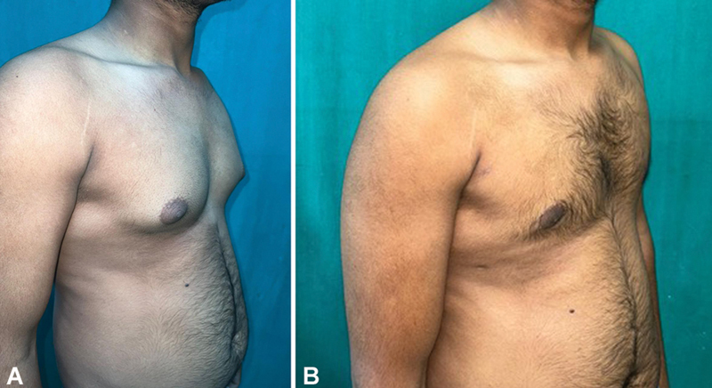 Gynecomastia Surgery: Liposuction Alone versus Liposuction with Endoscope-Assisted Glandular Excision-A Comparative Study.