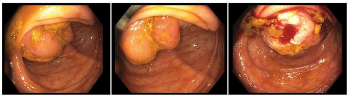 Endometriosis Presenting as a Malignant Appearing Cecal Mass.