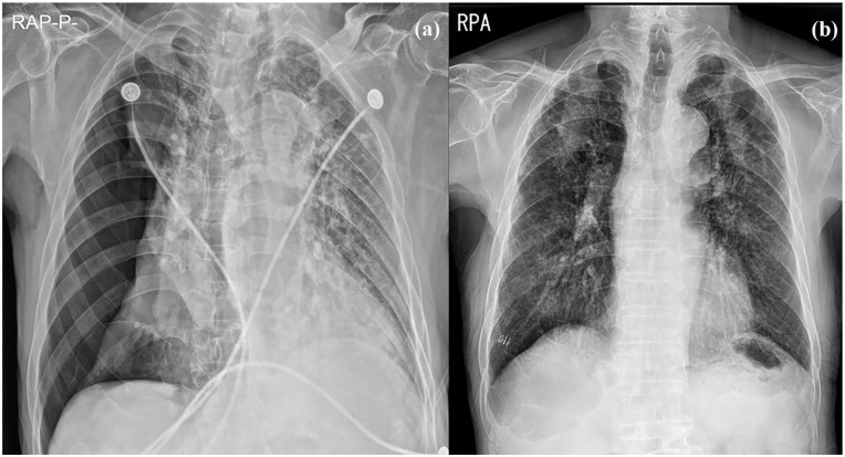 Relatively Safer and Efficient Pleurodesis With 50% DW for Very Elderly Patients With Secondary Spontaneous Pneumothorax: Report of 2 Cases.