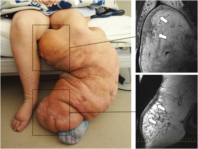 Massive Lymphedema in the Calf Complicated by Severe Skin Fibrosclerosis.