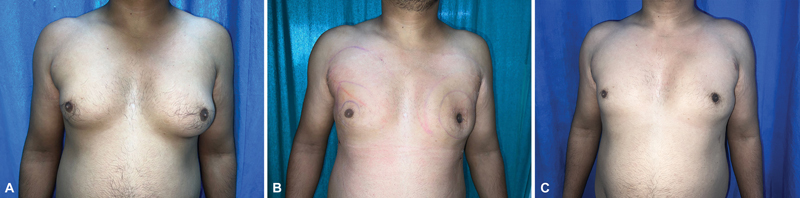 Gynecomastia Surgery: Liposuction Alone versus Liposuction with Endoscope-Assisted Glandular Excision-A Comparative Study.
